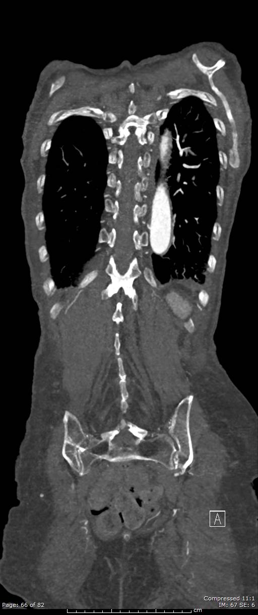 Aortic dissection with extension into aortic arch branches (Radiopaedia 64402-73204 A 66).jpg