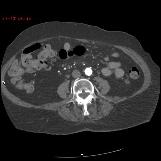 Aortic intramural hematoma (Radiopaedia 27746-28001 A 131).jpg