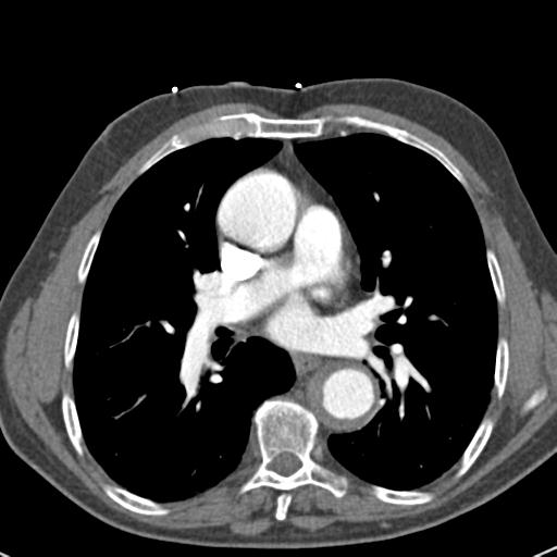 Aortic intramural hematoma (Radiopaedia 31139-31838 B 46).jpg