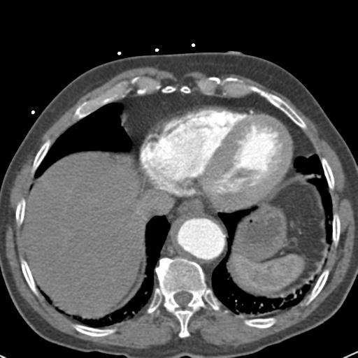 Aortic intramural hematoma (Radiopaedia 31139-31838 B 68).jpg