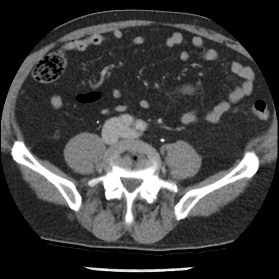 Aortic intramural hematoma (type B) (Radiopaedia 79323-92387 Axial C+ delayed 85).jpg