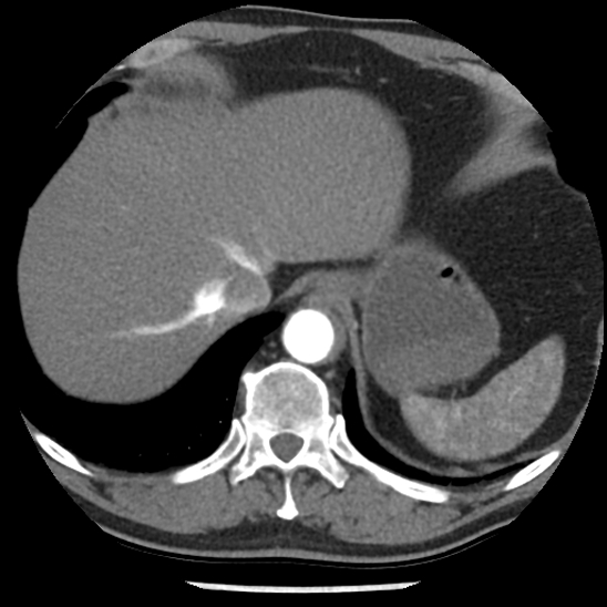 Aortic intramural hematoma (type B) (Radiopaedia 79323-92387 B 48).jpg