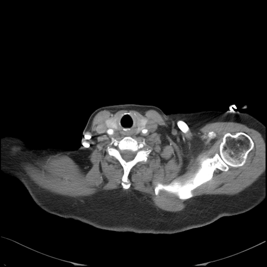 File:Aortic intramural hematoma with dissection and intramural blood pool (Radiopaedia 77373-89491 B 18).jpg