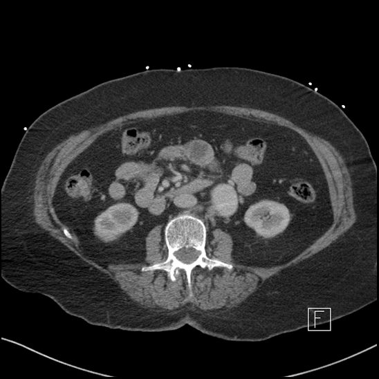 Aortic intramural hematoma with dissection and intramural blood pool (Radiopaedia 77373-89491 E 37).jpg