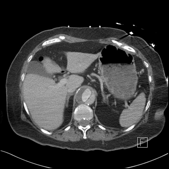 Aortic intramural hematoma with dissection and intramural blood pool (Radiopaedia 77373-89491 E 9).jpg