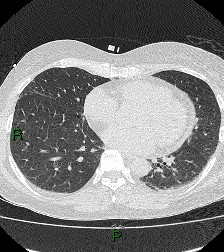 File:Aortic valve endocarditis (Radiopaedia 87209-103485 Axial lung window 64).jpg