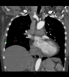 Aortic valve endocarditis (Radiopaedia 87209-103485 D 37).jpg