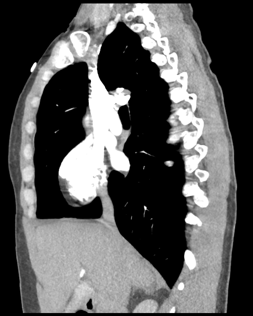 Aortic valve non-coronary cusp thrombus (Radiopaedia 55661-62189 D 32).png