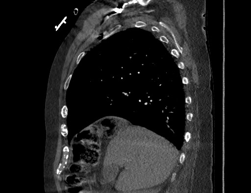 Aortoesophageal fistula with endovascular repair (Radiopaedia 73781-84592 Sagittal C+ CTPA 52).jpg