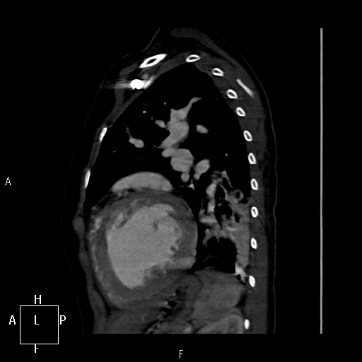 File:Aortopulmonary septal defect (Radiopaedia 41990-45013 Sagittal C+ CTPA 7).jpg