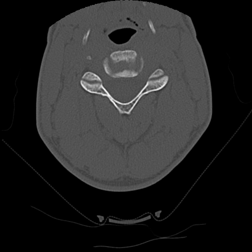 File:Apical pneumothorax on cervical spine CT (Radiopaedia 45343-49368 Axial bone window 37).jpg