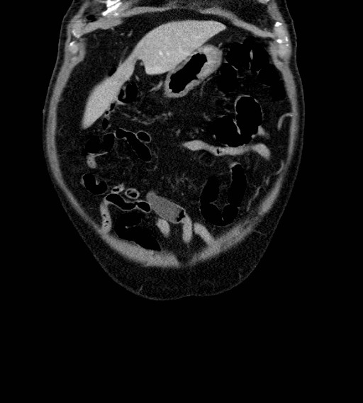 Appendiceal adenocarcinoma complicated by retroperitoneal abscess (Radiopaedia 58007-65039 A 16).jpg