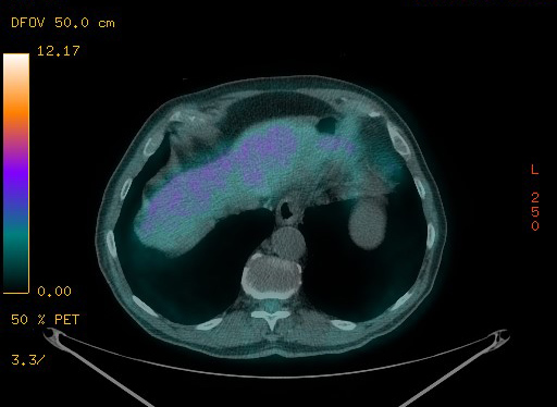 Appendiceal adenocarcinoma complicated by retroperitoneal abscess (Radiopaedia 58007-65041 Axial PET-CT 99).jpg