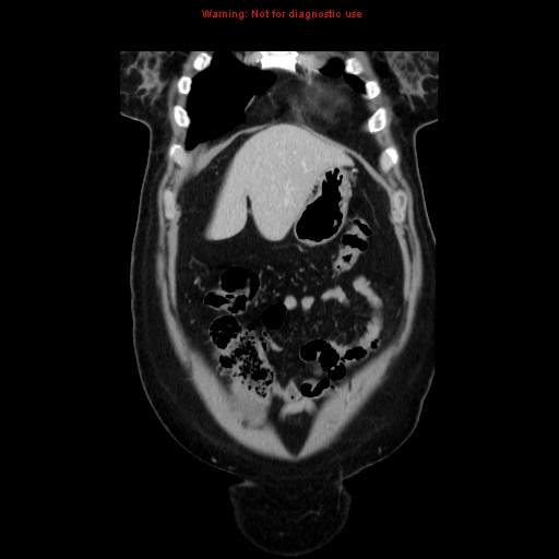 Appendiceal mucinous cystadenoma (Radiopaedia 8263-9111 B 14).jpg