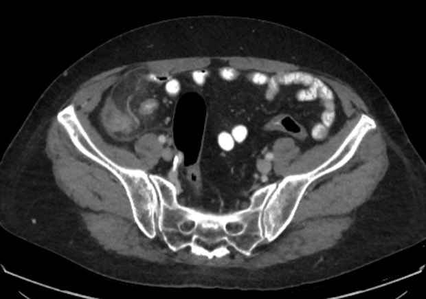 File:Appendicitis due to chicken fibula (Radiopaedia 74314-85198 A 28).jpg