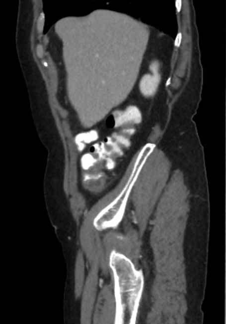 Appendicitis due to chicken fibula (Radiopaedia 74314-85198 C 17).jpg
