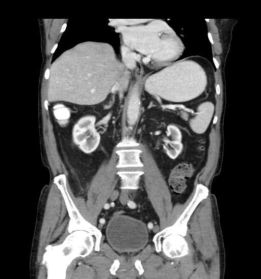Appendicitis with localized perforation and abscess formation (Radiopaedia 49035-54130 B 27).jpg