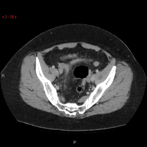 Appendicitis with microperforation- promontoric type (Radiopaedia 27268-27442 C 64).jpg