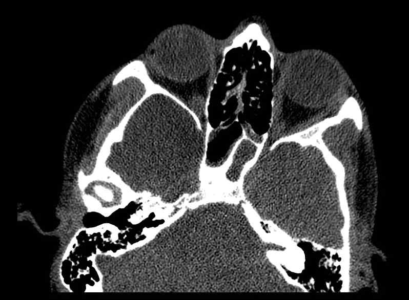 File:Arachnoid cyst- extremely large (Radiopaedia 68741-78450 Axial bone window 16).jpg