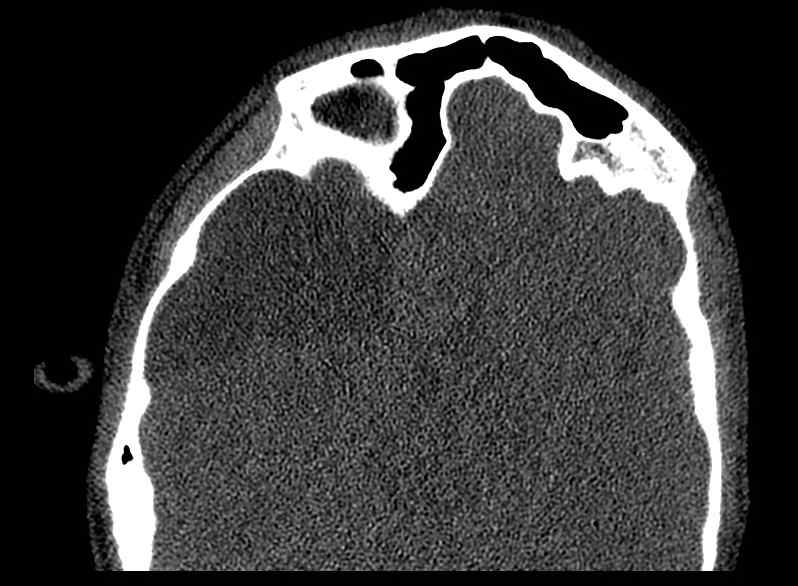 Arachnoid cyst- extremely large (Radiopaedia 68741-78450 Axial bone window 40).jpg