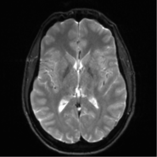 Arachnoid cyst - cerebellopontine angle (Radiopaedia 59689-67083 Axial DWI 19).png