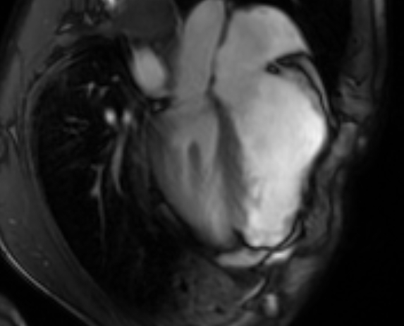 Arrhythmogenic right ventricular cardiomyopathy (Radiopaedia 69564-79464 4ch cine 86).jpg