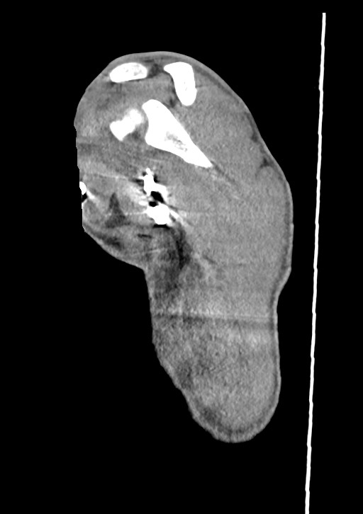 Arrow injury in the neck (Radiopaedia 75268-86390 G 18).jpg
