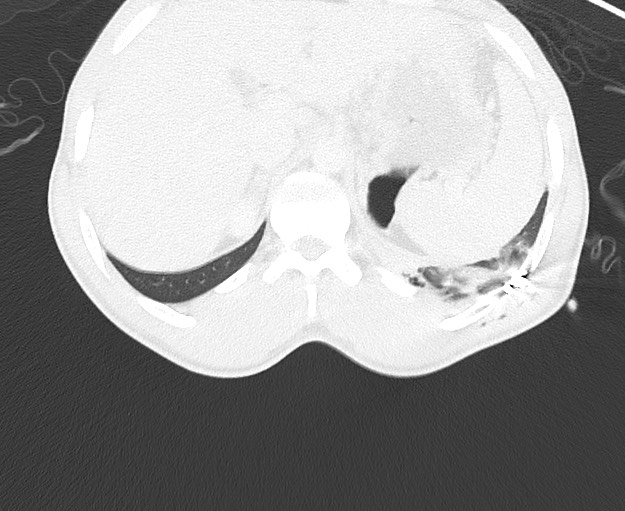 File:Arrow injury to the chest (Radiopaedia 75223-86321 Axial lung window 100).jpg