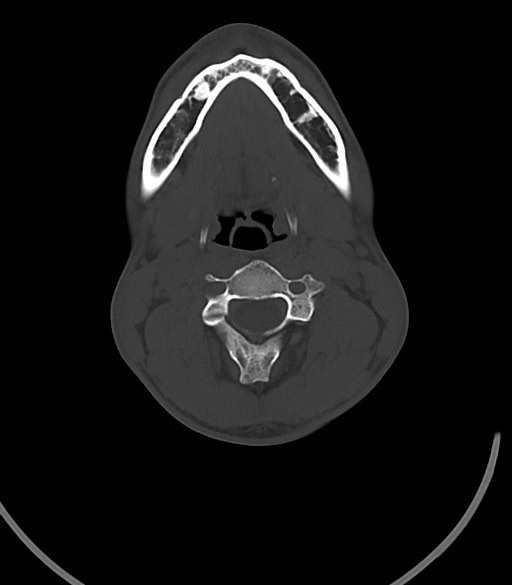 Arrow injury to the face (Radiopaedia 73267-84011 Axial bone window 23).jpg