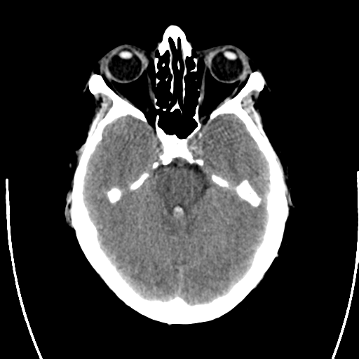 File:Arteriovenous malformation (cerebral) (Radiopaedia 40070-42579 Axial non-contrast 11).png