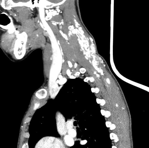 Arteriovenous malformation of the neck (Radiopaedia 53935-60062 C 38).jpg