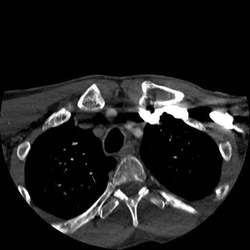 Artery of Percheron infarct (Radiopaedia 48088-52894 A 16).jpg