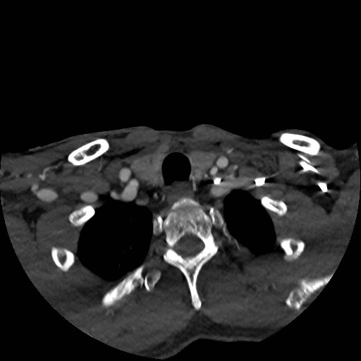 Artery of Percheron infarct (Radiopaedia 48088-52894 A 30).jpg