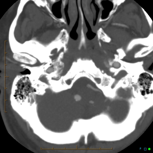 File:Artifactual basilar artery stenosis due to metallic stent (Radiopaedia 31206-31923 A 6).jpg