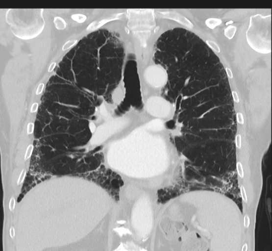 Asbestosis (Radiopaedia 56192-62864 Coronal lung window 29).png