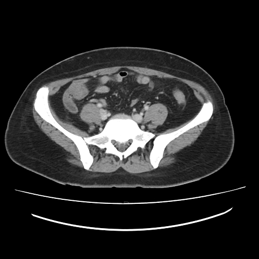File:Ascending retrocecal appendicitis with liver abscesses (Radiopaedia 60066-67615 B 65).jpg