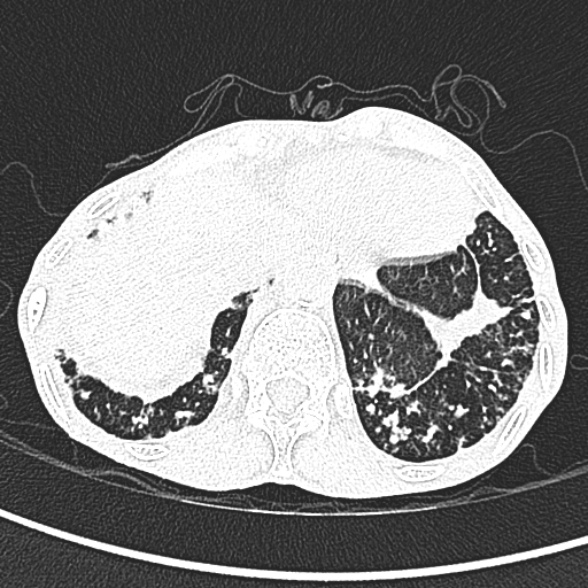 Aspergilloma- with Monod sign (Radiopaedia 44737-48532 Axial lung window 267).jpg