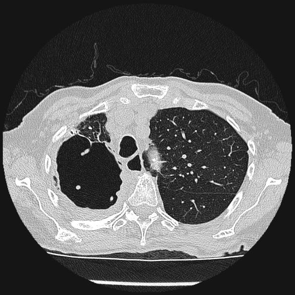 Aspergilloma (Radiopaedia 24458-24763 Axial lung window 15).jpg
