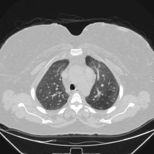 Aspergilloma (Radiopaedia 39611-41932 Axial lung window 33).jpg