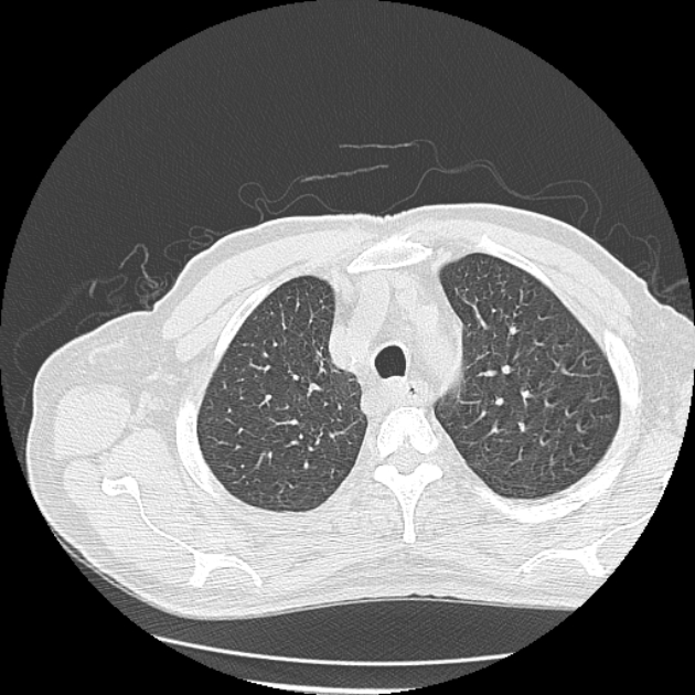 Aspergilloma (Radiopaedia 44592-48327 Axial lung window 14).jpg
