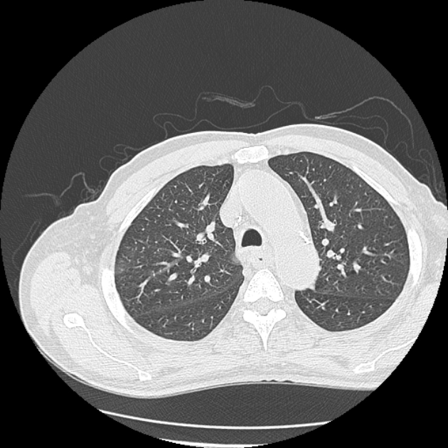 Aspergilloma (Radiopaedia 44592-48327 Axial lung window 23).jpg