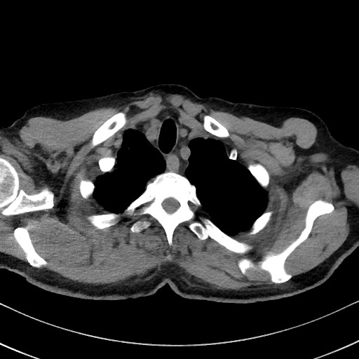 Aspergilloma on background pulmonary fibrosis (Radiopaedia 60942-68757 Axial non-contrast 9).jpg