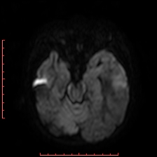 Astroblastoma (Radiopaedia 74287-85162 Axial DWI 33).jpg