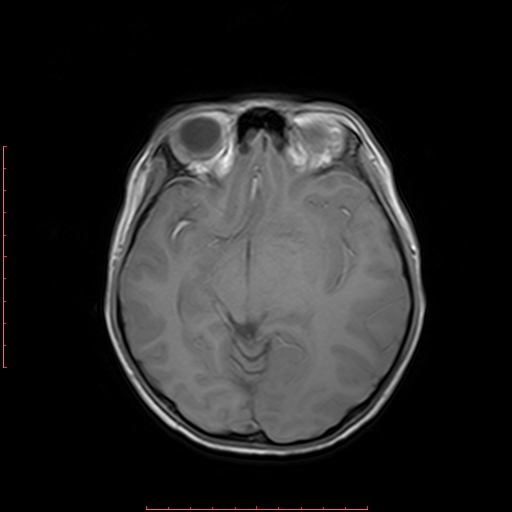 File:Astroblastoma (Radiopaedia 74287-85162 Axial T1 9).jpg