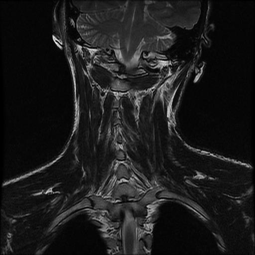 File:Atlas fracture (Radiopaedia 64277-73052 Coronal T2 2).jpg