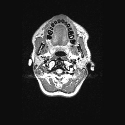Atretic encephalocoele with inferior vermis hypoplasia (Radiopaedia 30443-31108 Axial 11).jpg