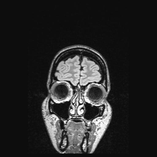 Atretic encephalocoele with inferior vermis hypoplasia (Radiopaedia 30443-31108 Coronal FLAIR 160).jpg
