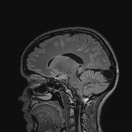 Atretic encephalocoele with inferior vermis hypoplasia (Radiopaedia 30443-31108 Sagittal FLAIR 94).jpg