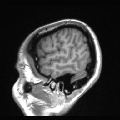 Atretic encephalocoele with inferior vermis hypoplasia (Radiopaedia 30443-31108 Sagittal T1 118).jpg