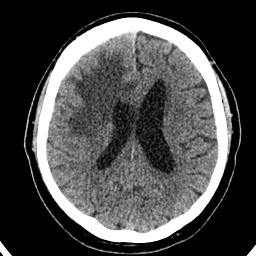 File:Atypical meningioma (WHO grade II) with brain invasion (Radiopaedia 57767-64728 Axial non-contrast 27).png